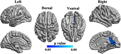 Association of brain morphology and phenotypic profile in patients with unruptured intracranial aneurysm